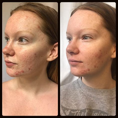 [B&A] - One week on Differin Gel | Differin gel, Skin, Gel