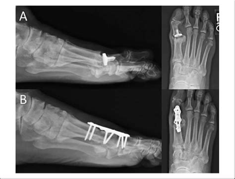 (A) Failed hemiarthroplasty. The patient experienced recurrent pain and ...