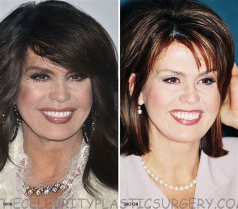 Did You Hear About Marie Osmond Plastic Surgery? - The Celebrity Plastic S… | Celebrity plastic ...