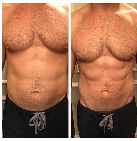 CoolSculpting for men in NYC - Just Melt Med Spa