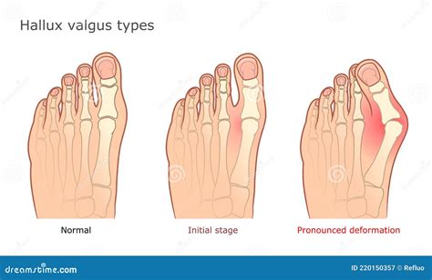 Hallux Valgus Surgery Correction. Cartoon Vector | CartoonDealer.com #204589267