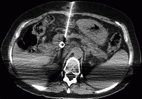 Percutaneous Biopsy | Radiology Key