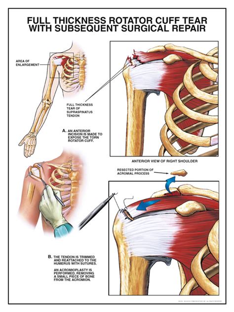 Full Thickness Rotator Cuff Tear with Subsequent Surgery