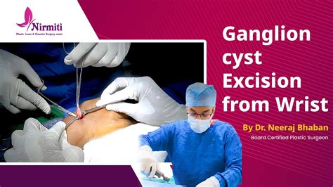 Ganglion Cyst Excision from Wrist Surgery | Expert Procedure by Dr. Neeraj Bhaban - YouTube