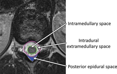 Nontraumatic Spinal Cord Compression: MRI Primer for Emergency Department Radiologists ...