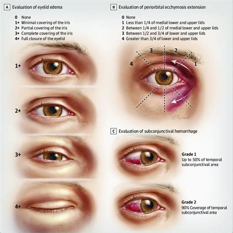 Differences in Postoperative Eyelid Edema, Periorbital Ecchymosis, and ...