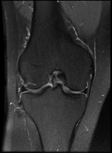 Knee - Stress Fracture - Home