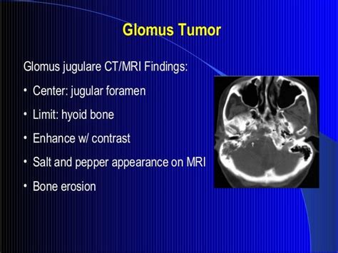 Glomus Tumor Ear