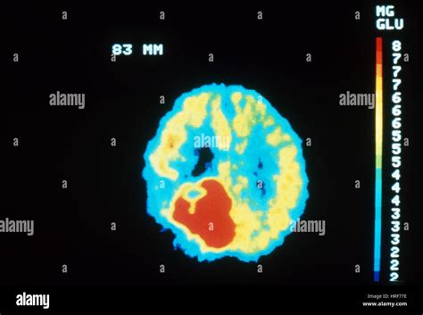 PET Brain Scan, Malignant Tumor Stock Photo - Alamy