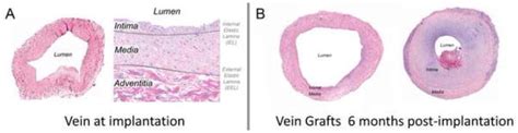 Vein Graft Histology: measurements conducted at the time of graft ...