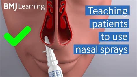 Teaching patients to use nasal sprays | BMJ Learning - YouTube