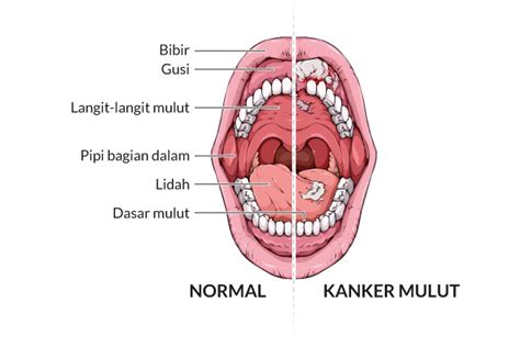 Kanker Mulut - Gejala, penyebab dan mengobati - Alodokter