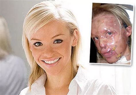 Acid attack model Katie Piper reveals she wanted to die after burns wrecked her face - Mirror Online