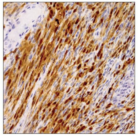 Malignant Peripheral Nerve Sheath Tumor | Basicmedical Key