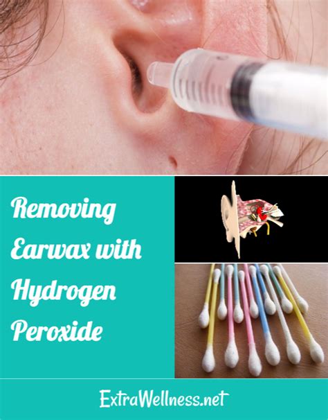 Removing Excessive Earwax with Hydrogen Peroxide