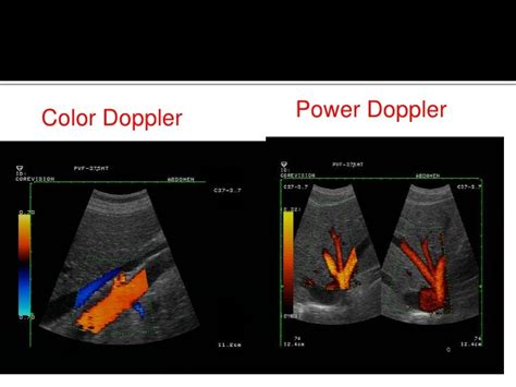 Understanding ultrasound