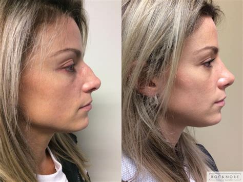 Rhinoplasty Before and After Pictures Case 349 | Albany, Latham & Saratoga, New York | Rockmore ...