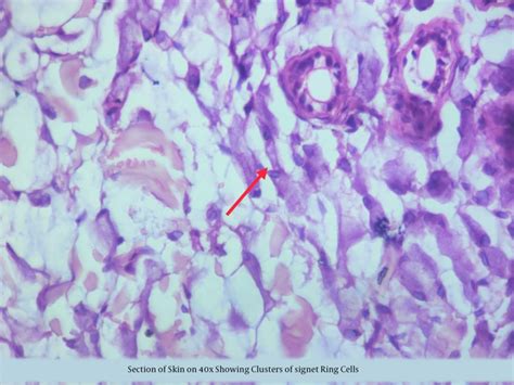 Cutaneous Metastasis of Signet Ring Cell Carcinoma: An Unusual Case Report | Journal of Skin and ...