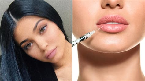 Lip Injections: The Negative Side Effects You May Not Know | Allure