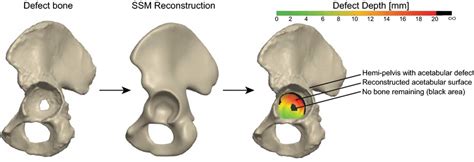 Native anatomy of the defect hemipelvis is reconstructed with high... | Download Scientific Diagram