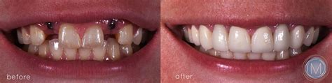 Before and After | Markiewicz Dentistry