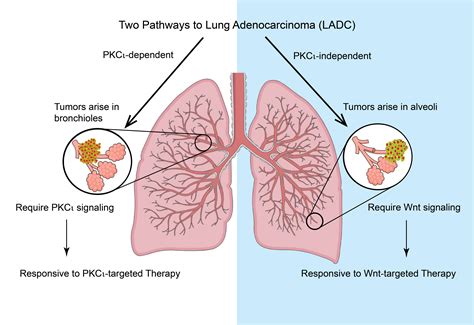 Discovery of distinct lung cancer pathways may lead to more targeted ...