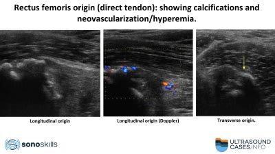 Calcific tendinopathy of the rectus femoris tendon: the ultrasound appearance / SonoSkills