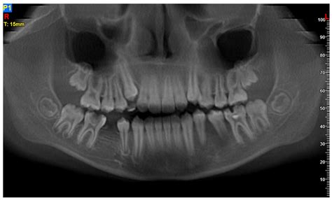 Diagnostics | Free Full-Text | The Primary Outbreaks of Burkitt Lymphoma in the Oral Cavity. A ...