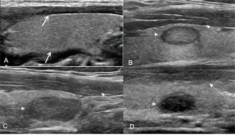 Does a three-degree hypoechogenicity grading improve ultrasound thyroid nodule risk ...