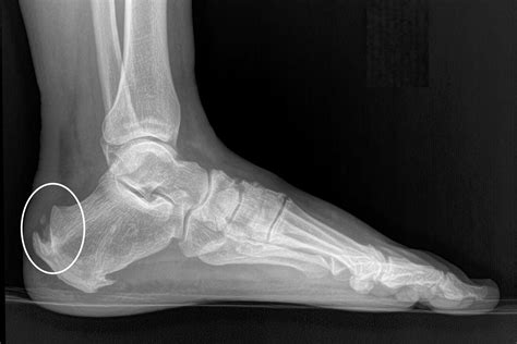 Achilles Tendonitis — Daniel Bohl, MD | Midwest Orthopaedics at RUSH