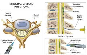 Lumbar Epidural Injection for Back Pain in NYC | Injections for Back Pain