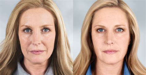 Sculptra- A Unique Non-Surgical Face Lift | Age Perfectly