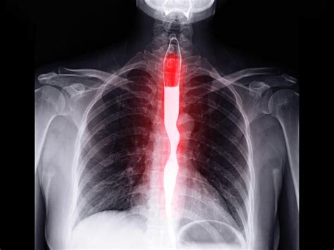 For Esophageal Cancer, Immunotherapy Likely to Play Larger Role - NCI