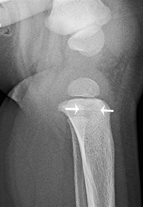 Who’s Brodie? Brodie abscess | Radiology Key