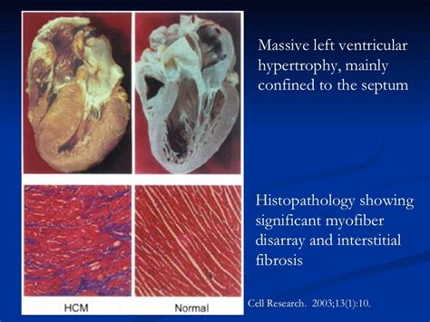 HYPERTROPHIC OBSTRUCTIVE CARDIOMYOPATHY (HOCM)