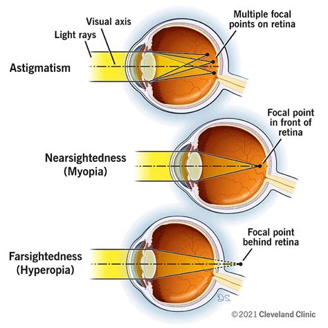 Astigmatism laser eye surgery | doctorvisit