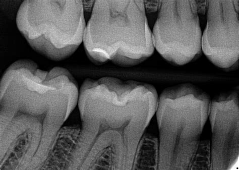 Instant and Accurate Detection of Early Occlusal Caries - Dentistry Today