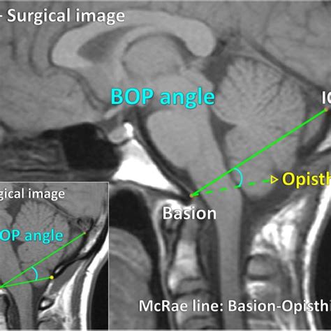 Reconstructed opisthion location and PCF height measurement errors for... | Download Scientific ...