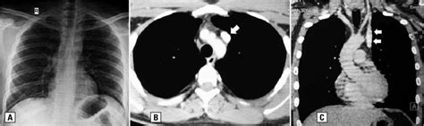 A. Frontal chest radiograph showing normal cardio-mediastinal contours;... | Download Scientific ...