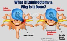 Lumbar laminectomy | back therapy | Spine surgery, Surgery recovery, Spinal stenosis