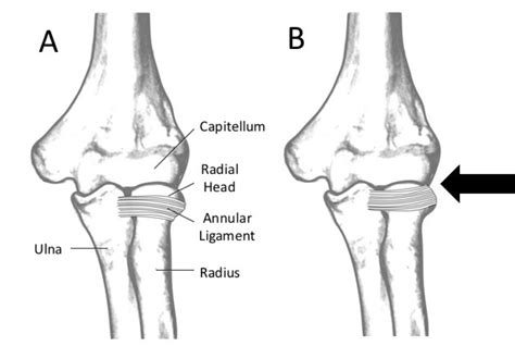 Radial Head Subluxation – Core EM