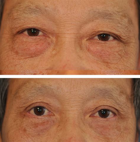 Asian Blepharoplasty - Photos - Northwest Eye Plastics