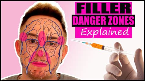 Facial Filler Danger Zones Visualisation | Avoid Filler Gone Wrong 2021 ...