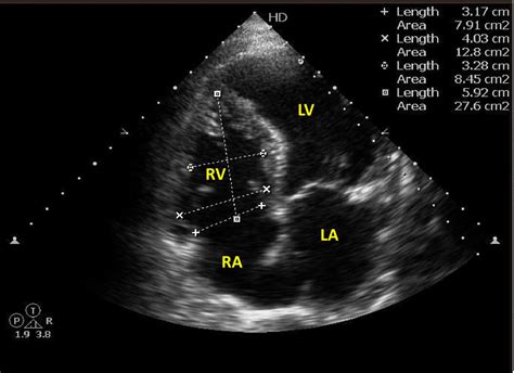 2D echo showing normal size of the right ventricle | Download Scientific Diagram