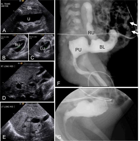 Radiological findings associated with prune belly syndrome in a 2 day ...