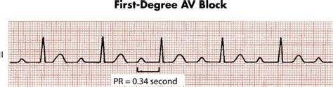 First degree atrioventricular block - ECG ~ Medicine Hack