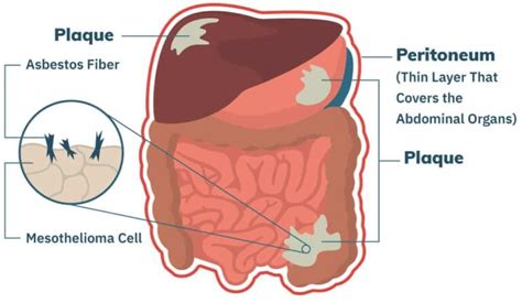 Mesothelioma Pictures | Mesothelioma.com