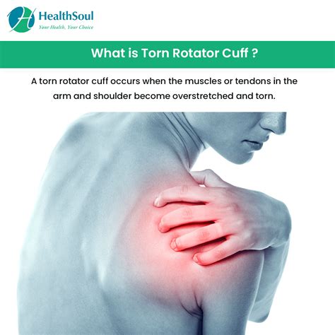 Torn Rotator Cuff: Symptoms, Diagnosis and Treatment – Healthsoul