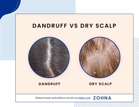 Dandruff vs Dry Scalp 2023 Guide: Differences, Causes & Solutions