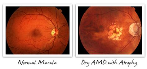 Dry & Wet AMD - Signs, Symptoms, and Diagnosis - Cure AMD Foundation